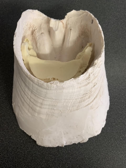 Chris Pollitt Foundered Hoof Capsule with Pathological Pedal Bone